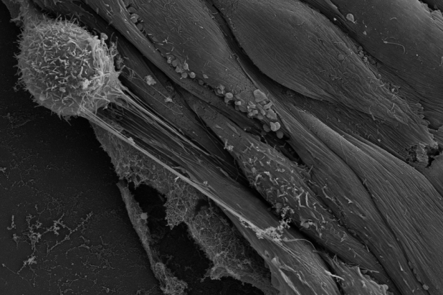 A rounded cancer cell (top left) sends out nanotubes connecting with endothelial cells. Genetic material can be injected via these nanotubes, transforming the endothelial cells and making them more hospitable to additional cancer cells. Image: Sengupta Lab