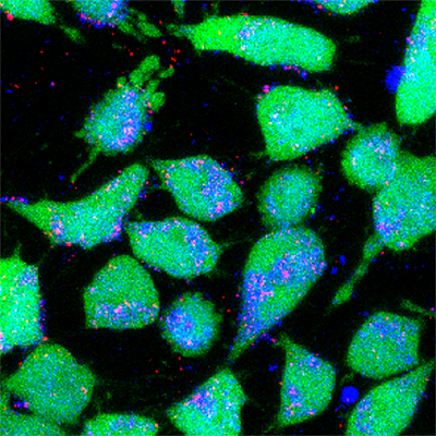 Image of cancer cells (green) taking up fluorescently labeled nanoparticles (red), demonstrating the possibility of more efficient delivery of traditional cancer drugs. (Image by Eric Song)