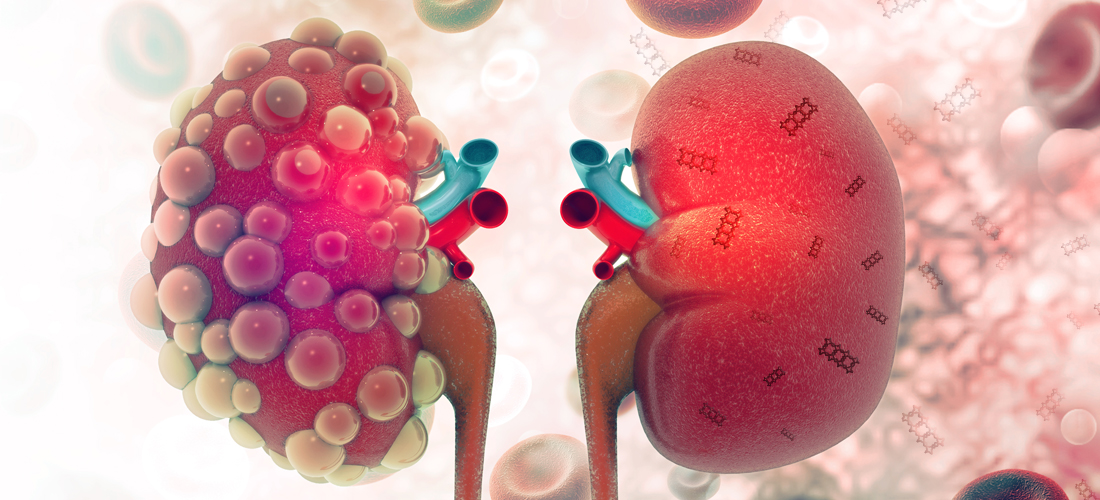 The illustration shows a diseased kidney on the left and a healthy kidney on the right, after rectangular DNA nanostructures migrated and accumulated in the kidney, acting to alleviate damage due to oxidative stress. Graphic by Shireen Dooling