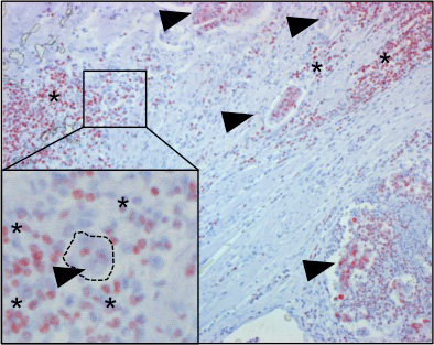 HMGB1 positive (red color indication) immune cells infiltrate a colon carcinoma. | © dkfz.de
