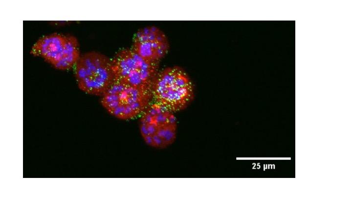 UI researchers loaded nanoparticles with two cancer drugs and injected them into lab mice with type II endometrial cancer. The super-lethal nanoparticles reduced tumor growth and extended survival rates. In this photo, tiny green nanoparticles attack red tumor cells. The violet areas represent tumor cell nuclei. @ Kareem Ebeid/UI College of Pharmacy.