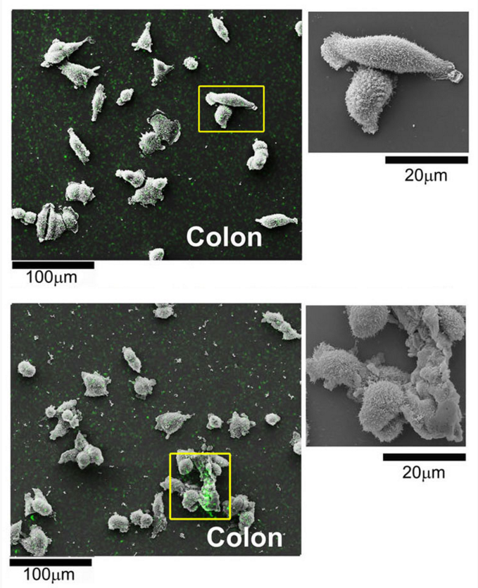 Above picture: The cancer cells that have not been treated have an elongated shape. Picture below: The cancer cells have absorbed the packages with cytotoxin and show signs that they are about to die. The green spots show regions with high concentration of the packages. (Credit: Bordallo and Martins, Niels Bohr Institute)
