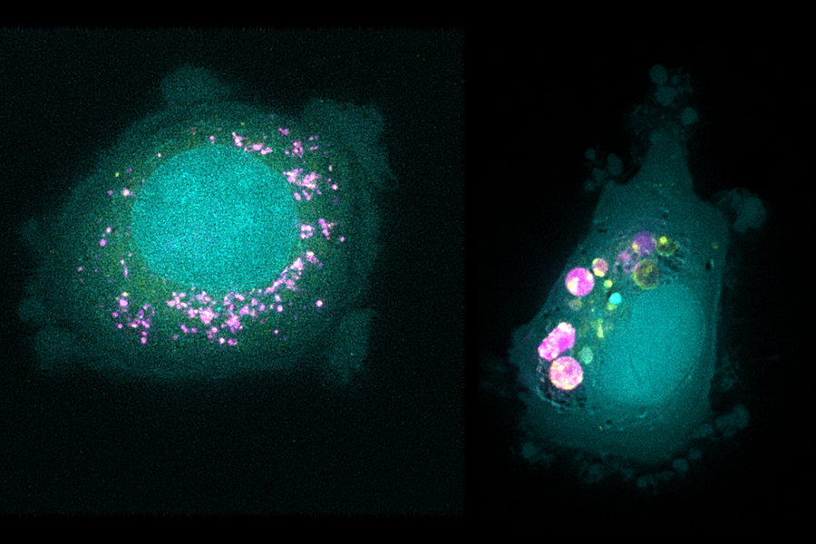 MIT researchers have identified biomarkers that predict whether different types of cancer cells will take up specific nanoparticles. In this image, cells with low levels of a protein called SLC46A3 (left) take up particles called liposomes (pink), while cells with high levels of SLC46A3 (right) do not. @ Courtesy of the researchers
