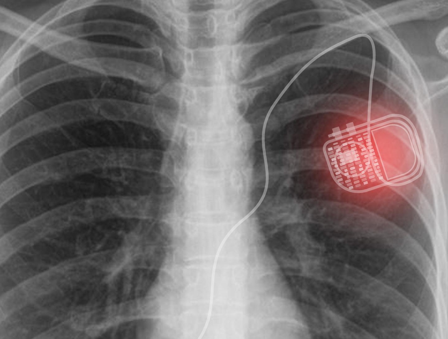 The use of medical implants in human bodies generates the need for invasive surgery to replace exhausted batteries, leading to a higher risk of surgical complications in patients @ Gwangju Institute of Science and Technology