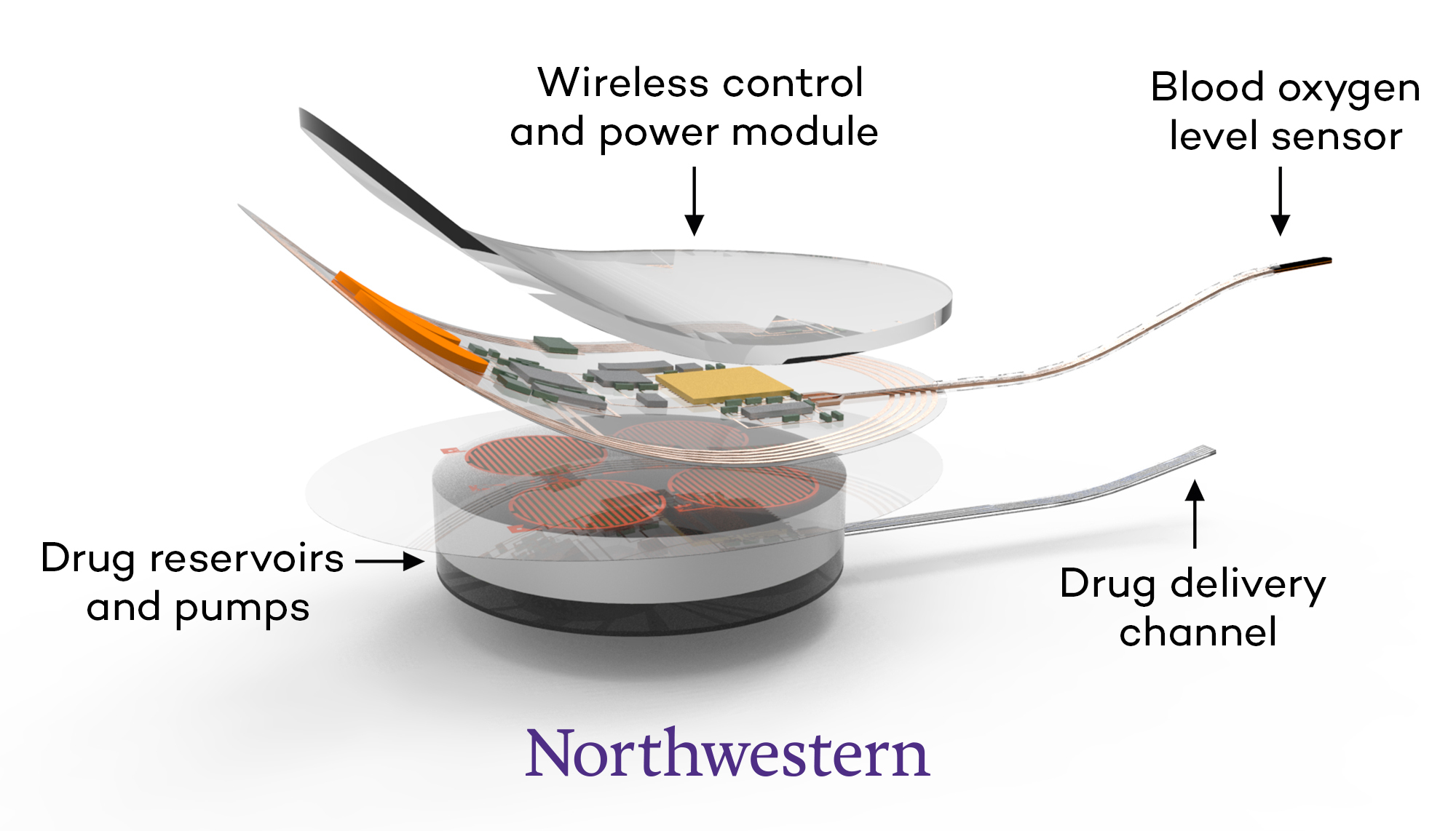 The closed-loop system senses dangerously low oxygen levels, associated with an opioid overdose, and immediately and automatically delivers naloxone. @ Northwestern University
