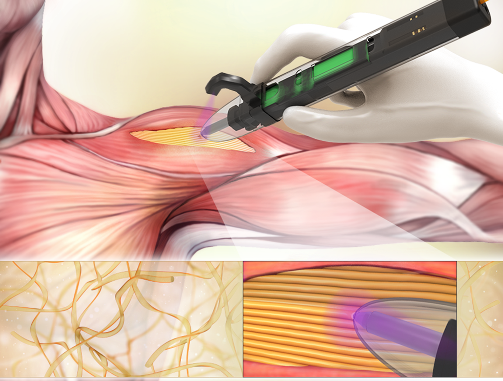 The bioprinter enables surgeons to deposit scaffolds—or materials to help support cellular and tissue growth—directly into the defect sites within weakened skeletal muscles. @ UConn